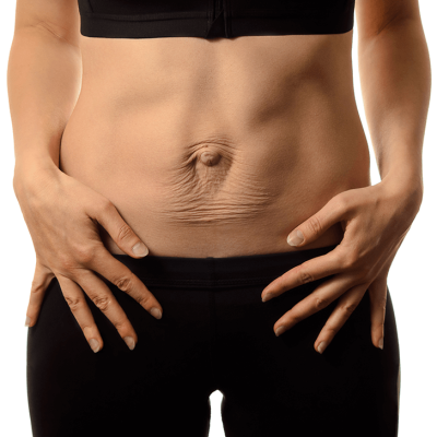 Should I Get A Tummy Tuck Or Liposuction? Tummy Tuck vs Liposuction. Absolutely Adell