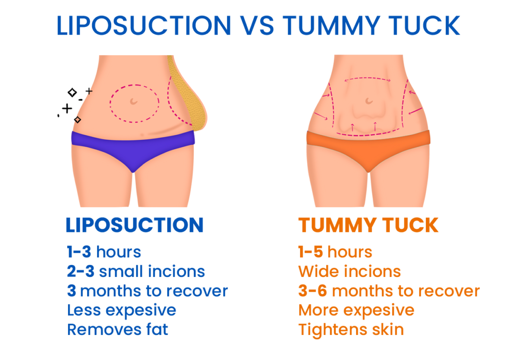 Should I Get A Tummy Tuck Or Liposuction? Tummy Tuck vs Liposuction. Absolutely Adell